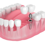 Future of Dental Implants: Safer, Smarter, and More Personalized Care
