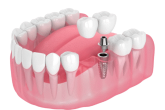 Future of Dental Implants: Safer, Smarter, and More Personalized Care