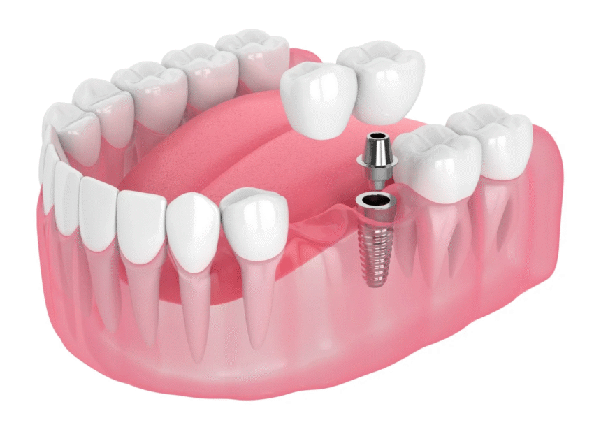 Future of Dental Implants: Safer, Smarter, and More Personalized Care